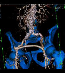 Occluded Left Iliac Artery With A Fem-fem Bypass - CTisus CT Scan