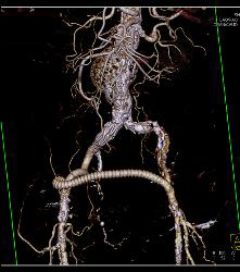 Occluded Left Iliac Artery With A Fem-fem Bypass - CTisus CT Scan