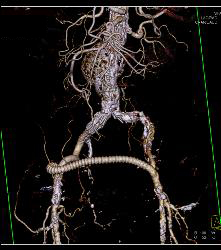 Occluded Left Iliac Artery With A Fem-fem Bypass - CTisus CT Scan