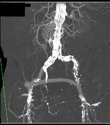 Occluded Left Iliac Artery With A Fem-fem Bypass - CTisus CT Scan