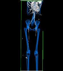 CTA Runoff With Occluded Left Popliteal Artery - CTisus CT Scan