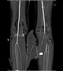 CTA Runoff With Occluded Left Popliteal Artery - CTisus CT Scan