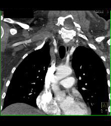 Cervical Rib With Occlusion of the Right Subclavian Artery- See Full Sequence - CTisus CT Scan