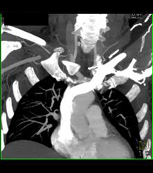 Cervical Rib With Occlusion of the Right Subclavian Artery- See Full Sequence - CTisus CT Scan