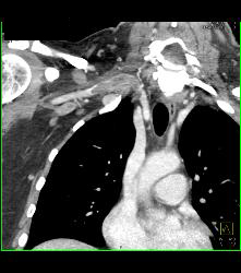 Cervical Rib With Occlusion of the Right Subclavian Artery- See Full Sequence - CTisus CT Scan