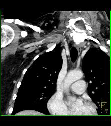 Cervical Rib With Occlusion of the Right Subclavian Artery- See Full Sequence - CTisus CT Scan