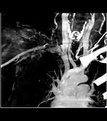 Cervical Rib With Occlusion of the Right Subclavian Artery- See Full Sequence - CTisus CT Scan