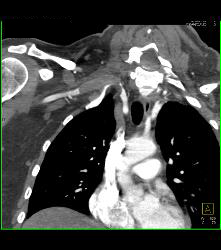 Cervical Rib With Occlusion of the Right Subclavian Artery- See Full Sequence - CTisus CT Scan