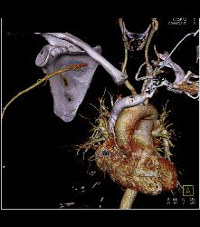 Cervical Rib With Occlusion of the Right Subclavian Artery- See Full Sequence - CTisus CT Scan