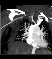 Cervical Rib With Occlusion of the Right Subclavian Artery- See Full Sequence - CTisus CT Scan