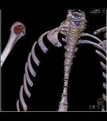 Cervical Rib With Occlusion of the Right Subclavian Artery- See Full Sequence - CTisus CT Scan