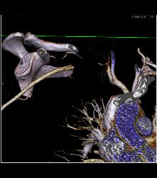 Cervical Rib With Occlusion of the Right Subclavian Artery- See Full Sequence - CTisus CT Scan