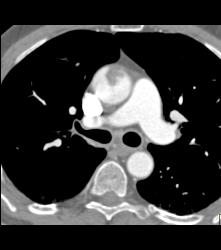 Thrombus in the Aortic Arch - CTisus CT Scan