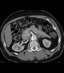 Aortic Dissection Extends Into the SMA - CTisus CT Scan