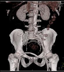 Occluded Right Common Iliac Artery - CTisus CT Scan