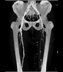 Peripheral Vascular Disease (PVD) - Left More Than Right - CTisus CT Scan