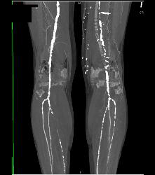 Peripheral Vascular Disease (PVD) - Left More Than Right - CTisus CT Scan