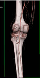 Normal Popliteal Artery - CTisus CT Scan