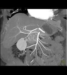 Right Hepatic Artery Arises Off the Superior Mesenteric Artery (SMA) and Left Hepatic Artery Arises Off the Aorta - CTisus CT Scan