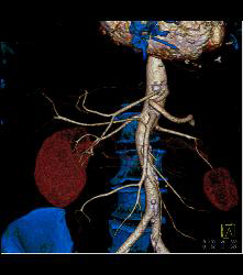 Right Hepatic Artery Arises Off the Superior Mesenteric Artery (SMA) and Left Hepatic Artery Arises Off the Aorta - CTisus CT Scan