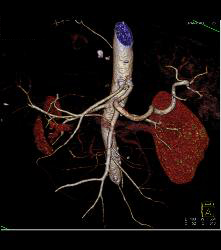 Right Hepatic Artery Arises Off the Superior Mesenteric Artery (SMA) and Left Hepatic Artery Arises Off the Aorta - CTisus CT Scan