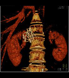 Inferior Vena Cava (IVC) Filter - CTisus CT Scan