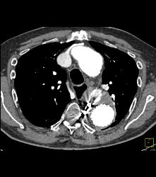 Endovascular Stent With Leak. Also Note Right Axillary Artery Aneurysm - CTisus CT Scan