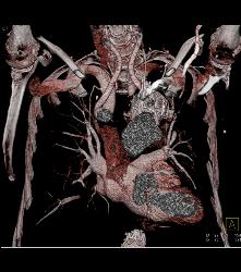 Endovascular Stent With Leak. Also Note Right Axillary Artery Aneurysm - CTisus CT Scan