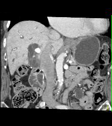 Atherosclerotic Disease Abdominal Aorta - CTisus CT Scan