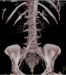 Atherosclerotic Disease Abdominal Aorta - CTisus CT Scan