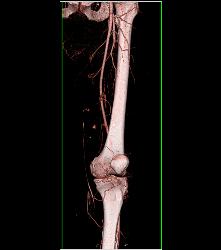 Thigh Hematoma Without Vascular Injury S/p Trauma - CTisus CT Scan