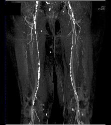 Significant Peripheral Vascular Disease (PVD) With Diseased External Iliacs, Superficial Femoral Artery (SFA), and Popliteal Artery Bilaterally - CTisus CT Scan