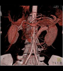 Retroaortic Left Renal Vein - CTisus CT Scan