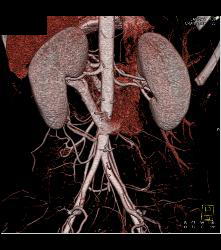 Retroaortic Left Renal Vein - CTisus CT Scan