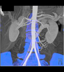 Retroaortic Left Renal Vein - CTisus CT Scan