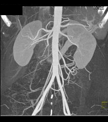 Retroaortic Left Renal Vein - CTisus CT Scan