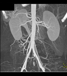 Retroaortic Left Renal Vein - CTisus CT Scan