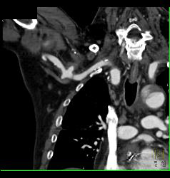 Trauma to Right Axillary Artery With Pseudoaneurysm - CTisus CT Scan