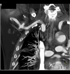 Trauma to Right Axillary Artery With Pseudoaneurysm - CTisus CT Scan