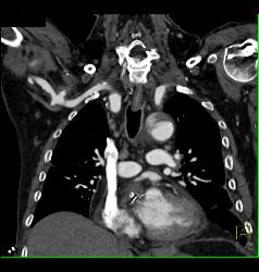 Trauma to Right Axillary Artery With Pseudoaneurysm - CTisus CT Scan