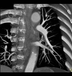 Pulmonary Embolism (PE) in Left Lobe Lung - CTisus CT Scan