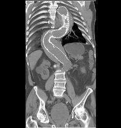 Endovascular Stent With Reimplanted Mesenteric Arteries - CTisus CT Scan