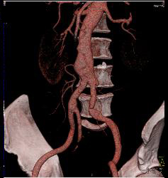 Endovascular Stent With Reimplanted Mesenteric Arteries - CTisus CT Scan