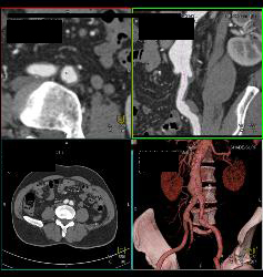 Left Iliac Artery Disease - CTisus CT Scan