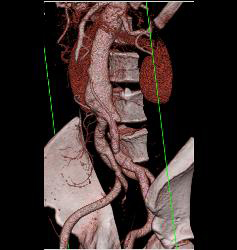 Left Iliac Artery Disease - CTisus CT Scan