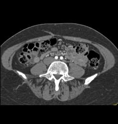 DIEP Flap Planning in 3D - CTisus CT Scan