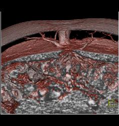 DIEP Flap Planning in 3D - CTisus CT Scan