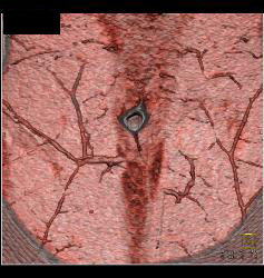 DIEP Flap Planning in 3D - CTisus CT Scan