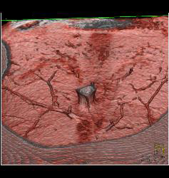 DIEP Flap Planning in 3D - CTisus CT Scan