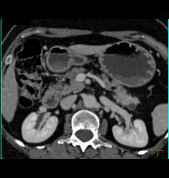 Intraductal Papillary Mucinous Neoplasm (IPMN) With Normal Splenic Artery and Vein - CTisus CT Scan